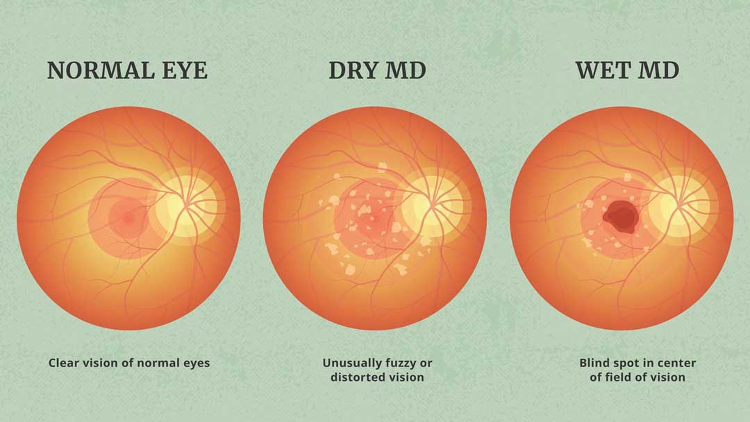 Age-related macular degeneration care at Kenia Eye Hospital