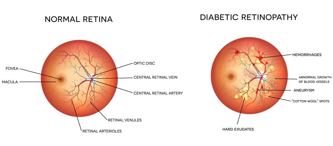 Diabetic retinopathy care at Kenia Eye Hospital