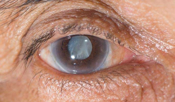 Diagnosis of glaucoma at Kenia Eye Hospital