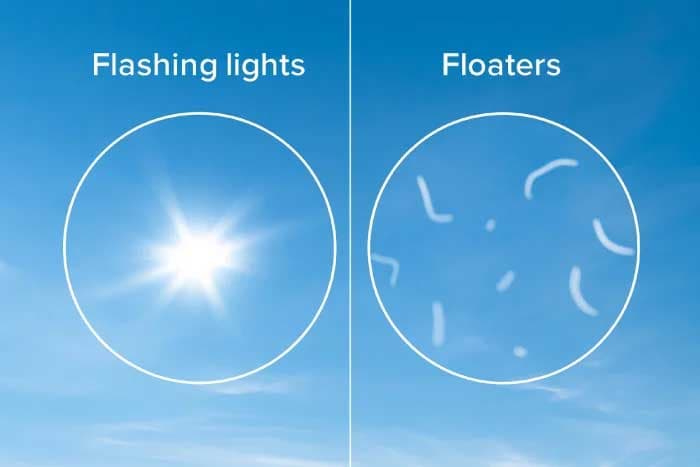 Flashes and floaters evaluation at Kenia Eye Hospital