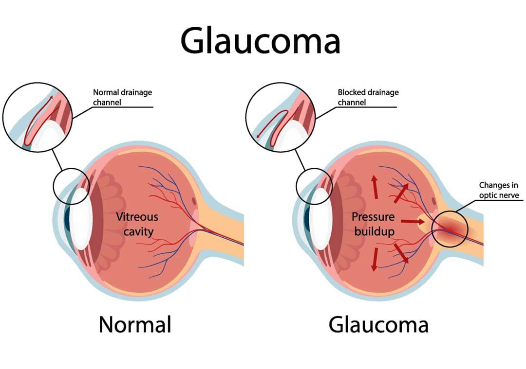 Glaucoma clinic at Kenia Eye Hospital
