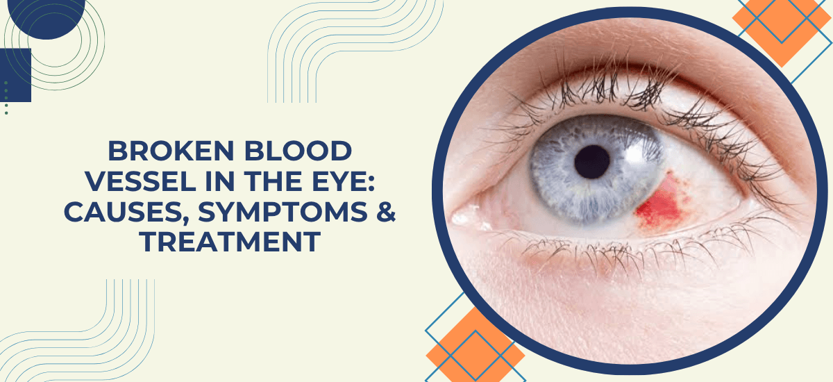 Broken Blood Vessel in the Eye (Subconjunctival Hemorrhage): Causes and When to Worry