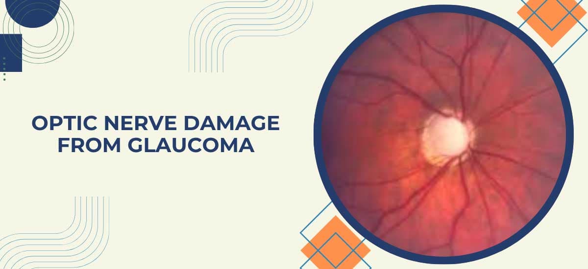 How Does Glaucoma Cause Optic Nerve Damage?