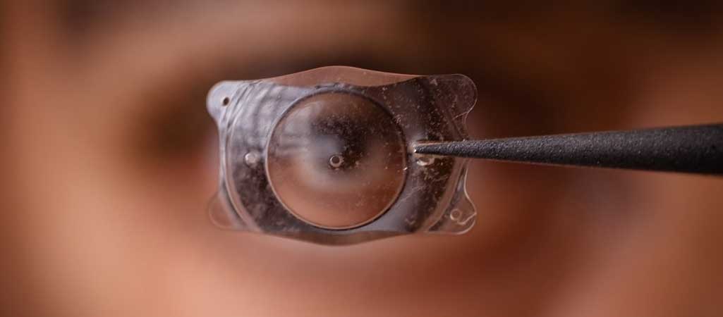 How ICL Surgery Works in
