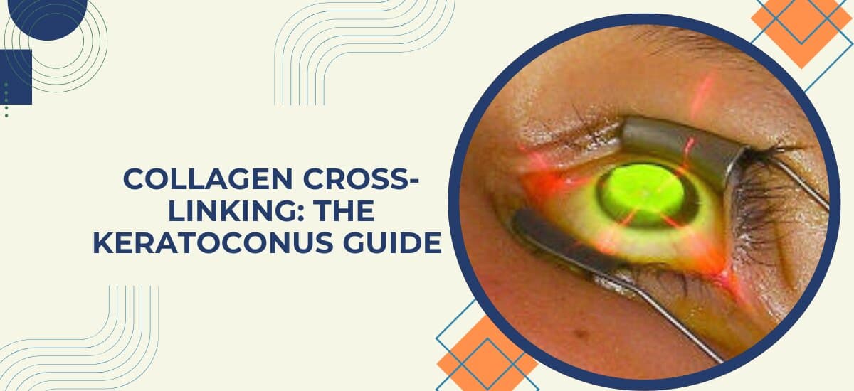 Collagen Cross-Linking: The Keratoconus Guide