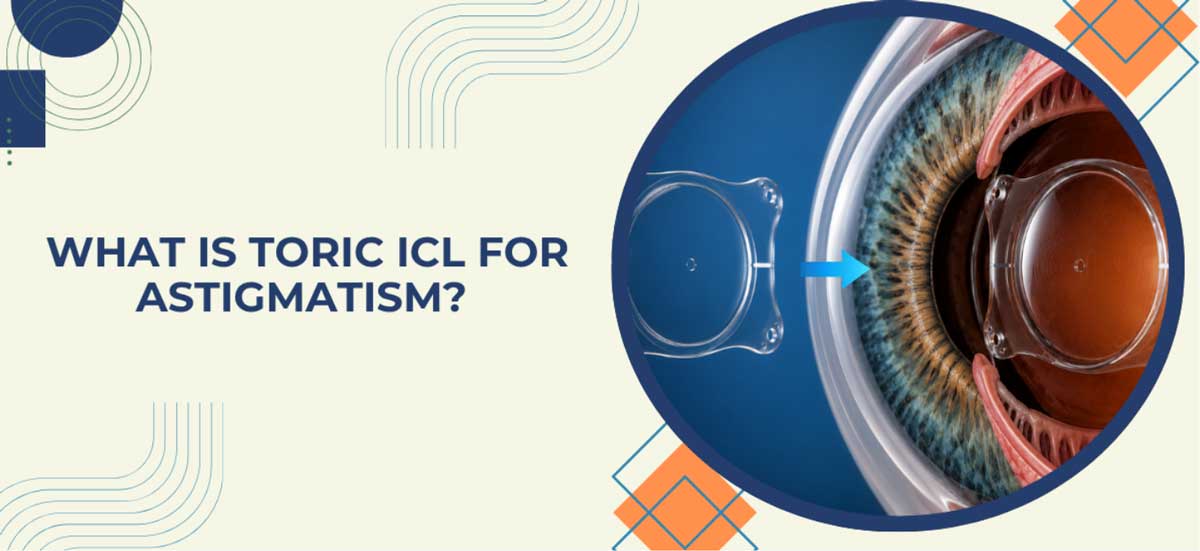 What Is Toric ICL for Astigmatism?