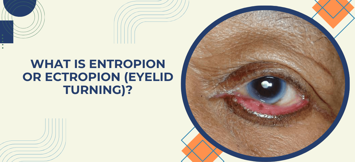 What Is Entropion or Ectropion (Eyelid Turning In or Out)?