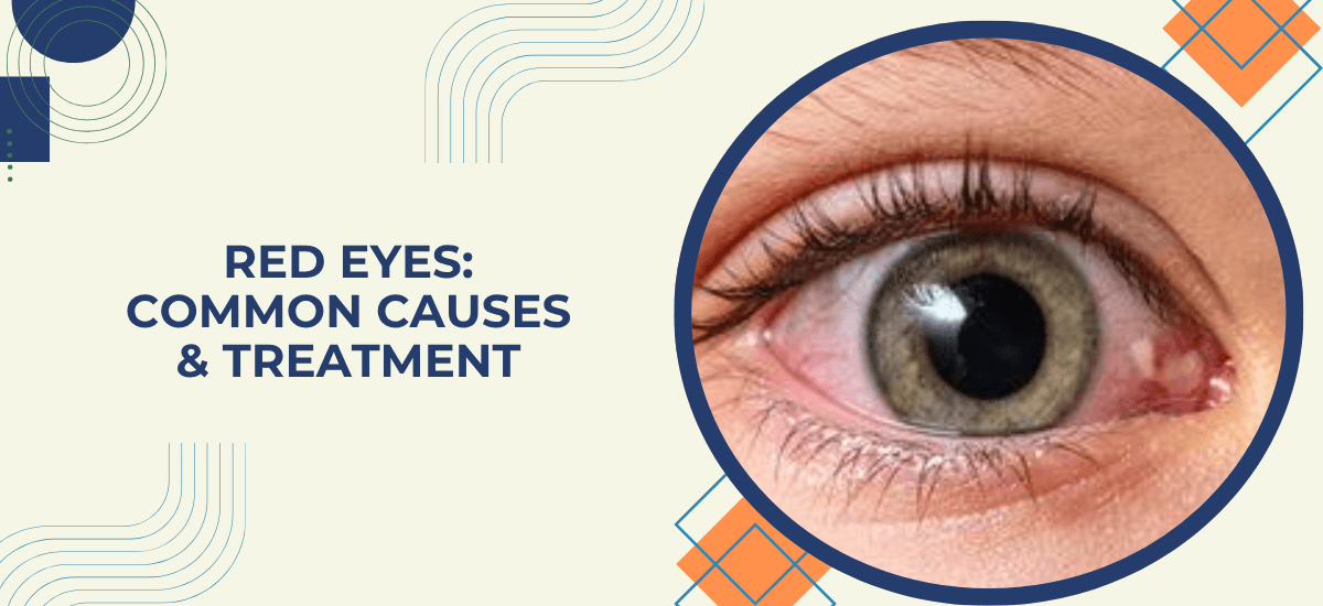 Red Eyes: Common Causes, Symptoms & Treatment