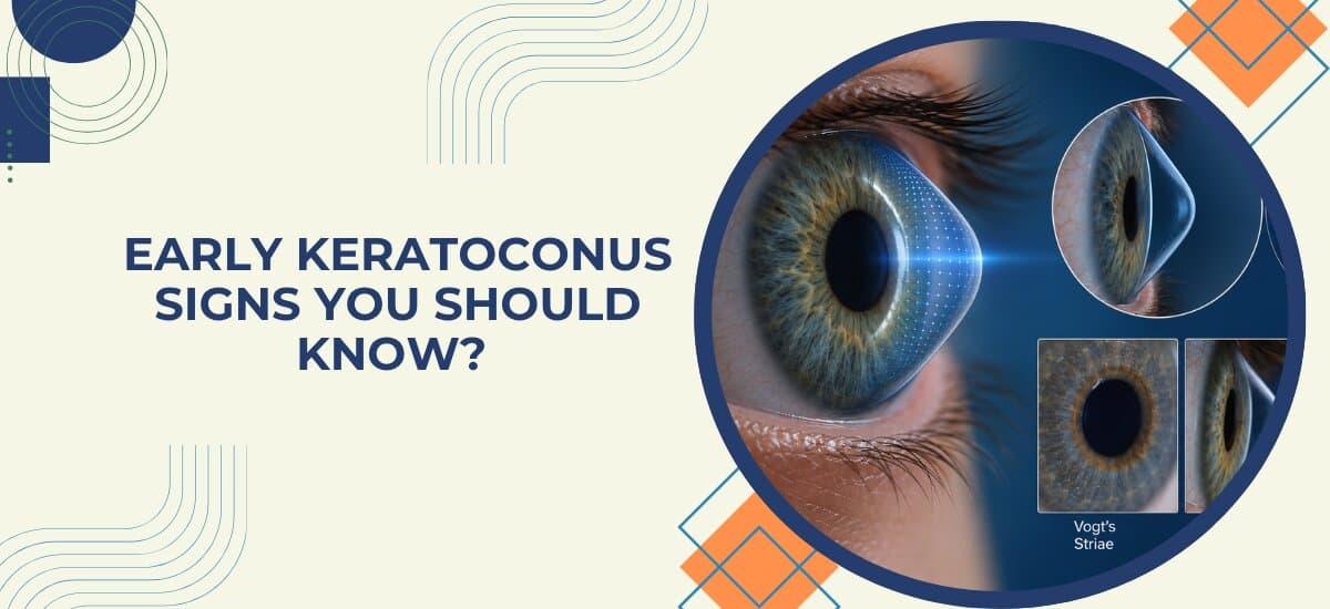 Early Keratoconus Signs You Should Know