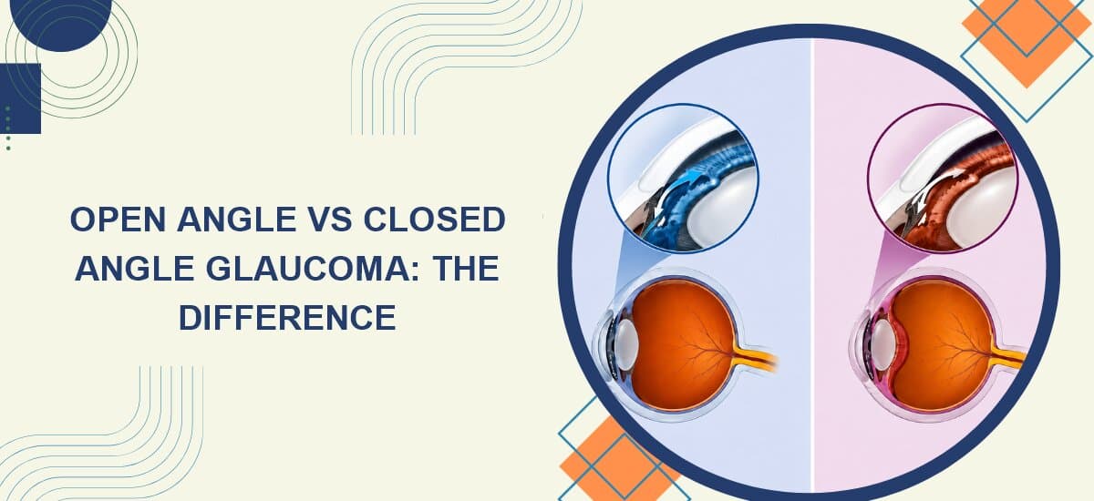 Open Angle vs Closed Angle Glaucoma: What's the Difference?