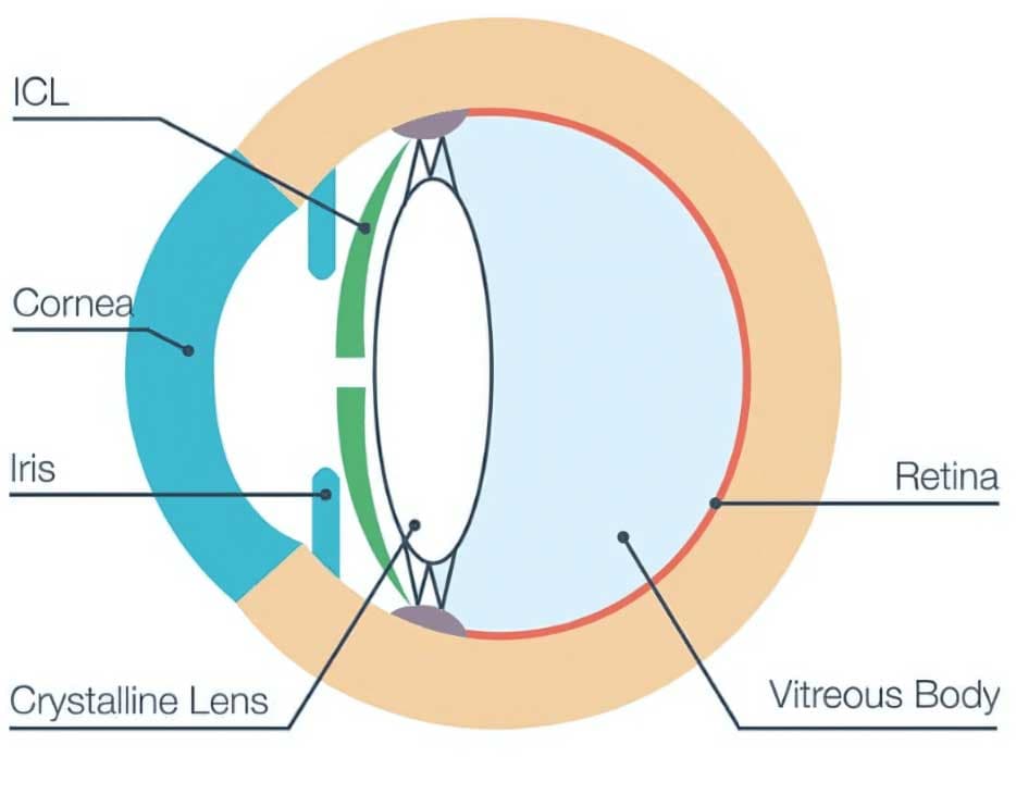 ICL surgery process at Kenia Eye Hospital