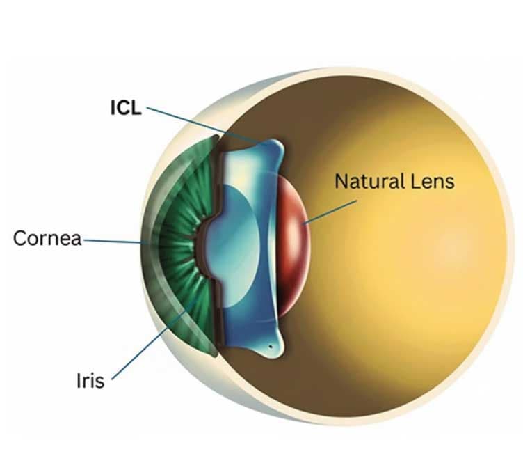 ICL vision correction lens treatment