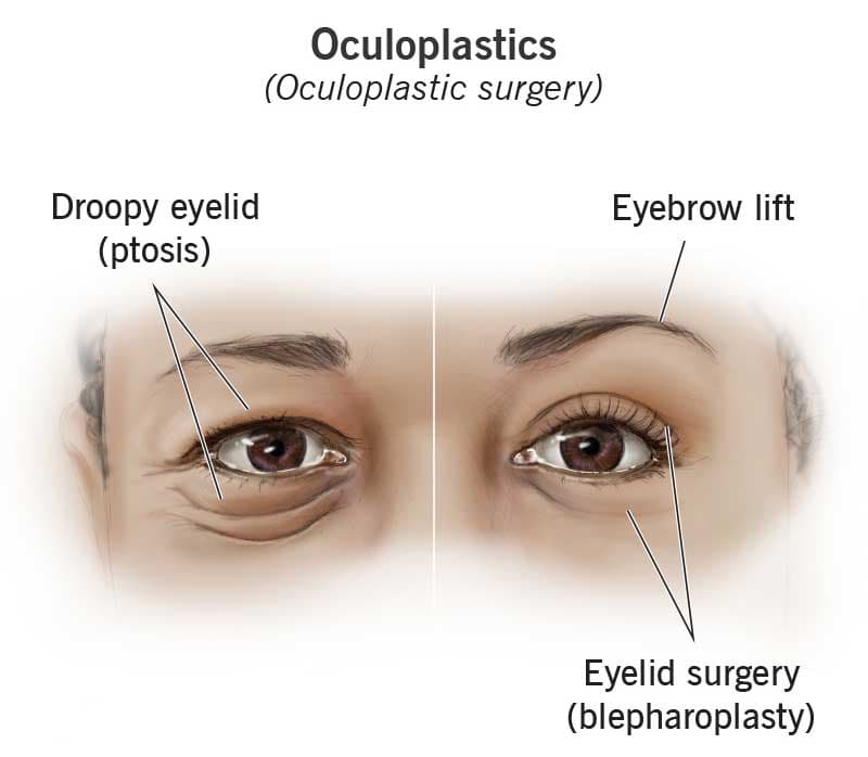 Oculoplastic Surgery