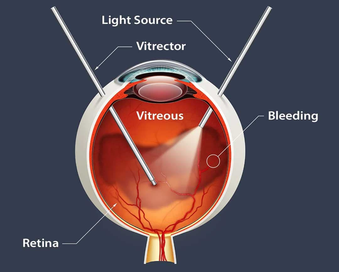 Retina treatment at Kenia Eye Hospital