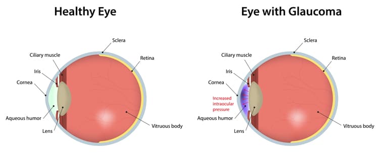 Symptoms of glaucoma at Kenia Eye Hospital