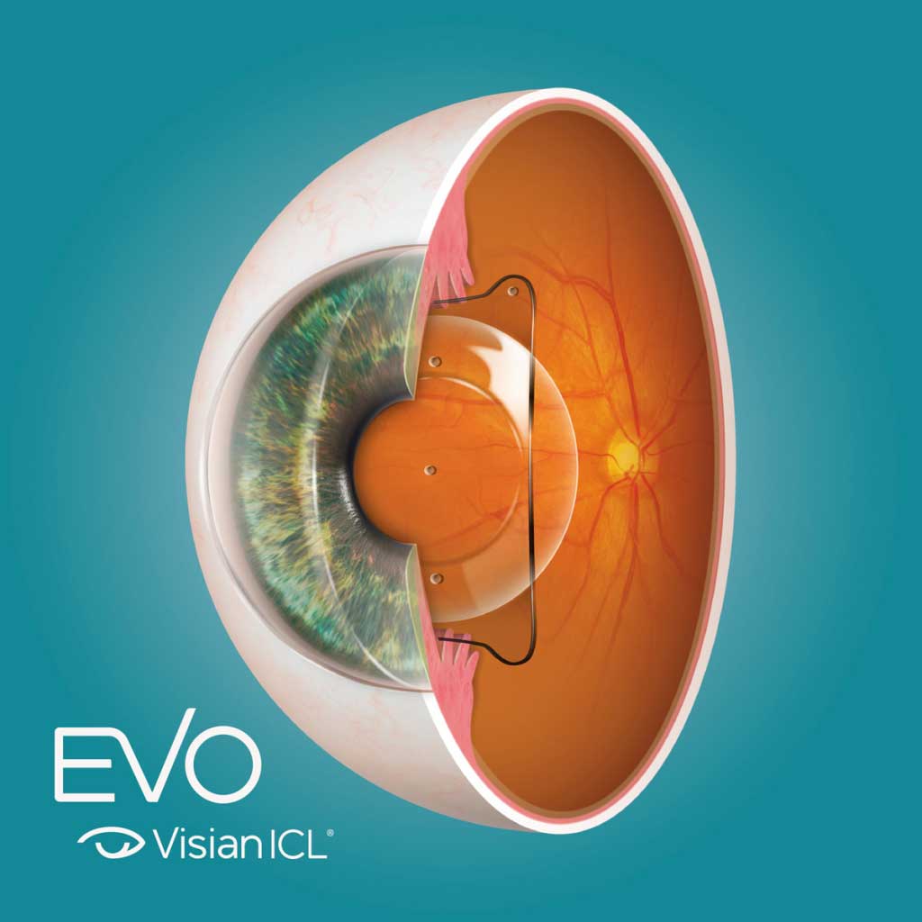 EVO ICL treatment at Kenia Eye Hospital