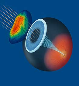 Wavefront Guided