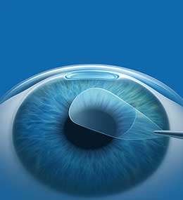 Flapless LASIK