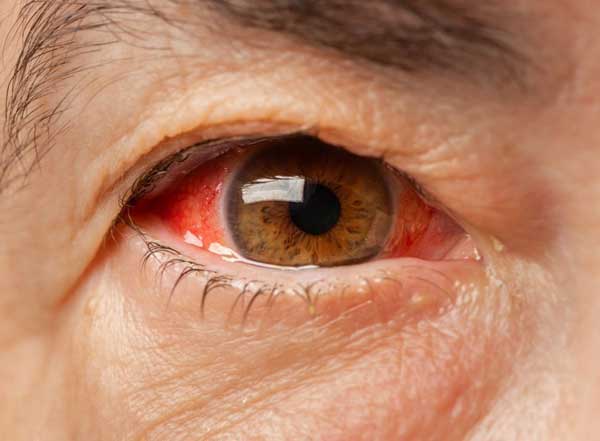 all about the pink eye
