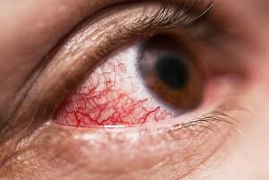 Contact lens eye infection