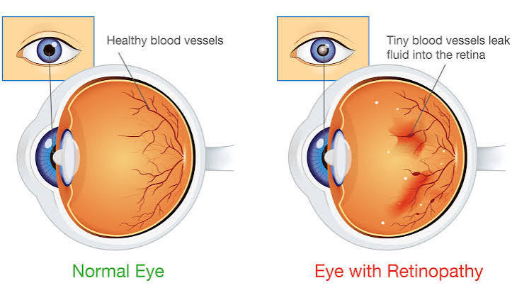 Comparison of a normal retina and a retina with leaking blood vessels from diabetic retinopathy