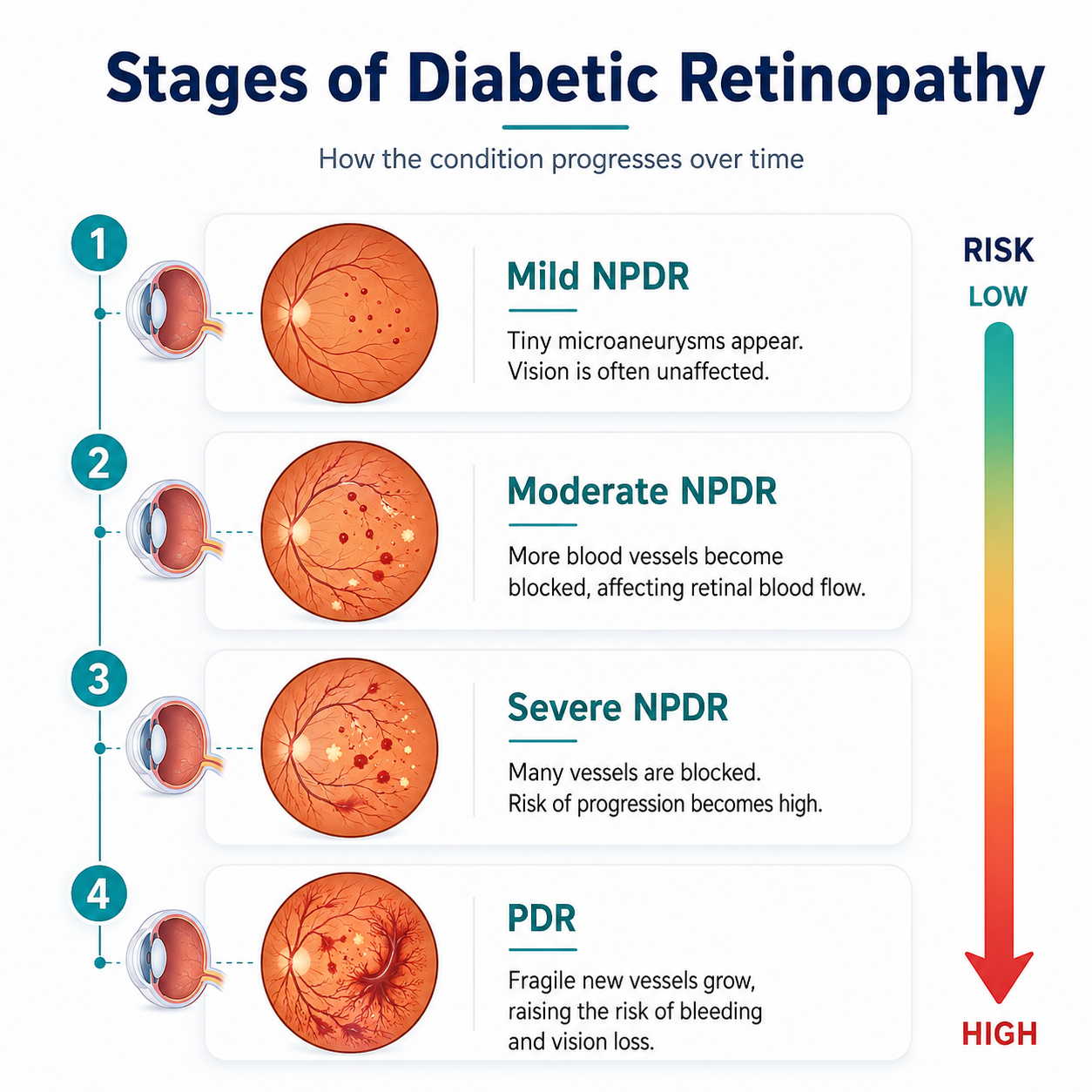 Four stages of diabetic retinopathy from mild NPDR to proliferative diabetic retinopathy