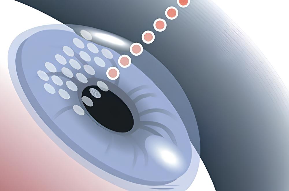 Image illustrating flapless LASIK eye surgery technique at Kenia Eye Hospital