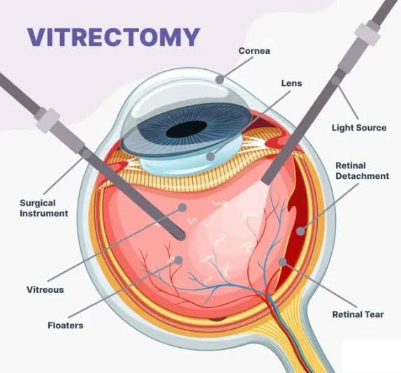 Vitrectomy surgery cost in Mumbai